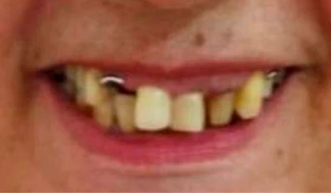 antes